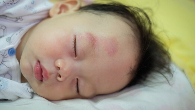 Penyebab Benjolan di Kepala Bayi dan Cara Menanganinya